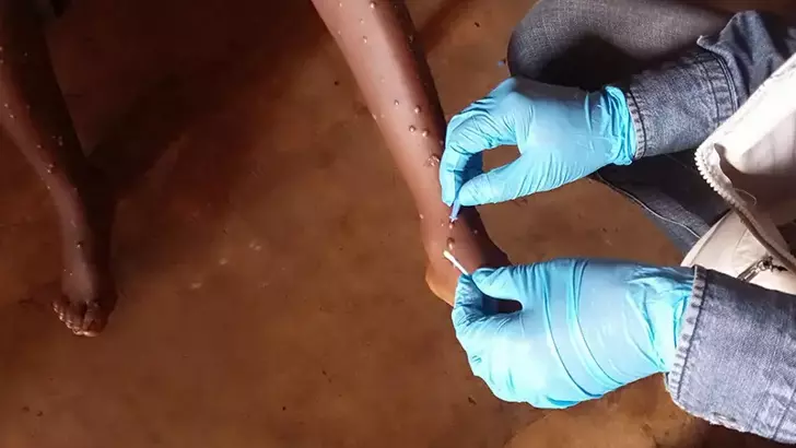 Dünya Sağlık Örgütü (DSÖ), Afrika’da yayılmaya başlayan maymun çiçeği (mpox)